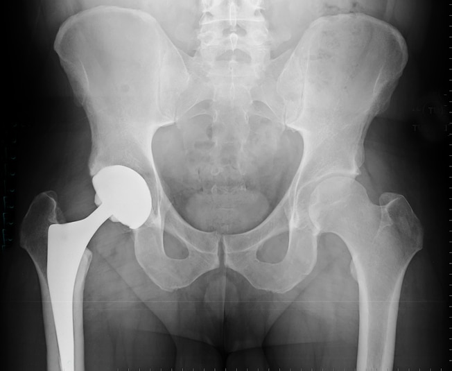 hip-implant-xray