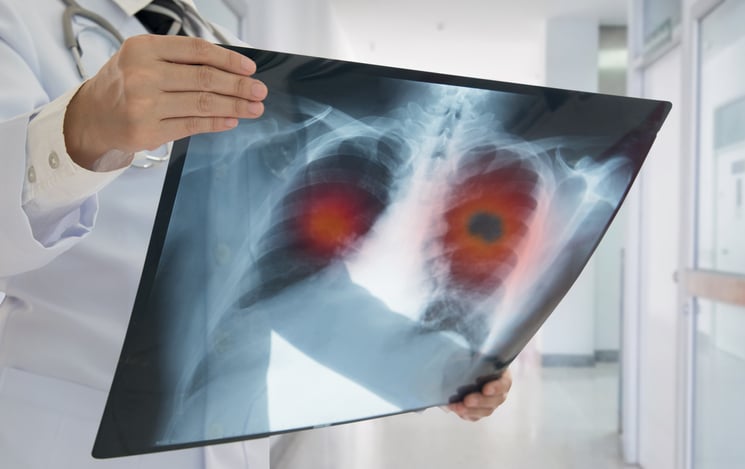 lung-cancer-x-ray