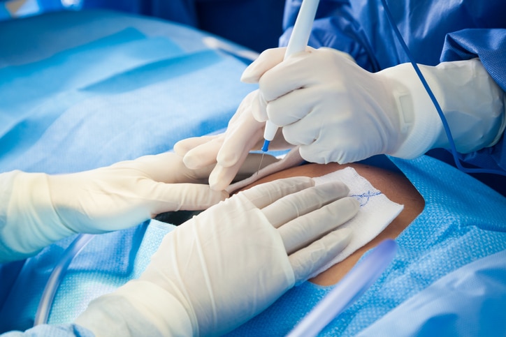 Cesarean Sections (C-Sections): Complications and Implications
