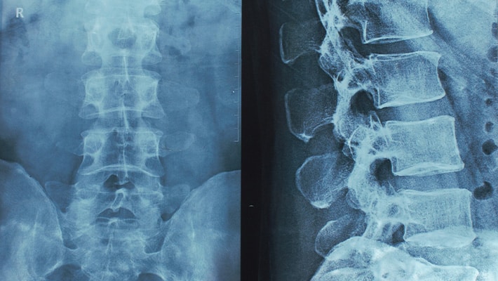 What Are Common Causes of Spinal Cord Injuries?