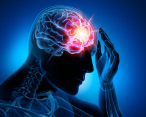 What Is a Concussion?